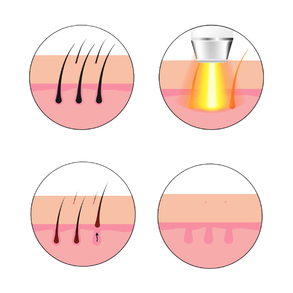 laser-removal-journey